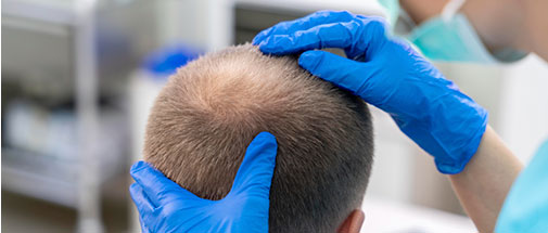 Tratamiento caida cabello